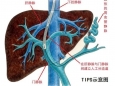 区内首例！血管介入外科联合介入治疗室3D融合技术助力TIPS术成功高效开展