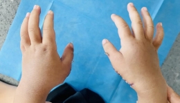 男孩天生12根手指，医生呼吁：“多指畸形”越早手术效果越好！
