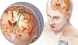 脑深部电刺激手术（DBS），帕金森患者隧道尽头的生命之光……