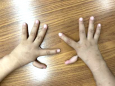 男孩拇指天生“漂浮”，食指再造变“拇指”——柳州市工人医院手足踝外科成功实施桂中地区首例示指拇化手术