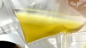 工医科普 | 血液里洗出黄“油”，原来是被你忽视的高脂血症